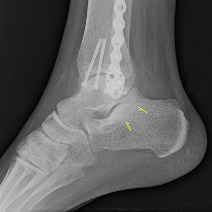 Case 1 Lateral XRay
